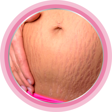 Applying cream to a belly with stretch marks